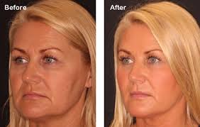 Check spelling or type a new query. Silhouette Soft Thread Lift Treatment Bedford Skin Clinic