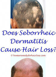 American academy of dermatology association: Losing Hair Stoplosinghair Hair Loss Men Sudden Hair Loss Natural Hair Loss Treatment