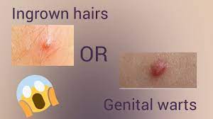 Ingrown hair ingrown hairs are common causes of bumps in the vaginal area. Genital Warts Or Ingrown Hair Are Those Really Ingrown Hairs Genital Warts Health Youtube