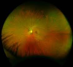 Optos retinal imaging the optos imaging technology allows us to give our patients a more thorough health evaluation. Optomap Testing Sunshine Eye Clinic