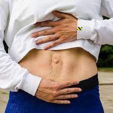 Diastasis Recti Surgery Preparation Recovery