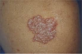 Scrofulodermaother namestuberculosis cutis colliquativa1specialtydermatology, infectious disease scrofuloderma is a skin condition caused by. References In Cutaneous Inoculation Tuberculosis In A Child Journal Of The American Academy Of Dermatology