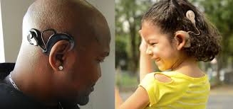 Image result for Cochlear Implant
