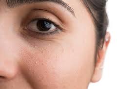 Maybe you would like to learn more about one of these? 5 Cara Mudah Dan Aman Menghilangkan Milia Hello Sehat