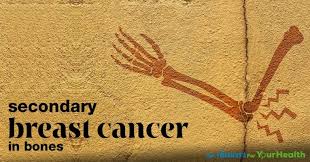Secondary breast cancer, bone cancer, spread to liver. Secondary Breast Cancer In Bone Health Solutions Plus