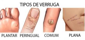 Arquivos Verruga Clinica Humaire Dermatologia Nutricao Bem Estar
