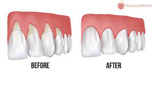 Grow Back Receding Gums With These Home Remedies Grow Back Receding Gums Dental Health Health Tips