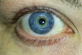 Keratoconus Group Blog Intacs For Keratoconus Photo By Helen Thompson Eye Surgery Helen Thompson Vision Eye