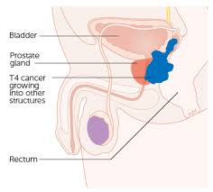 Since the cancer cells originated in the prostate gland, the cancer is referred to as metastatic prostate cancer. The Prostate Gland Structure Vasculature Lymph Teachmeanatomy