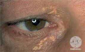 Image result for xantelasma