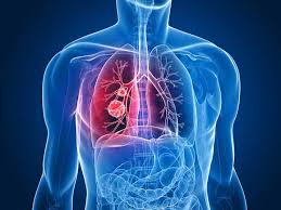 Chest pain worsening with laughing, deep breathing or coughing is often one of the early symptoms of lung cancer. Lung Cancer Facts Symptoms Diagnosis Treatment Gleneagles Hospital Singapore