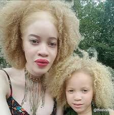 10 Stunning Photos Of Black Albinos From The Inmyskiniwin Campaign Celebrating Albino Beauty My Black Is Beautiful Natural Hair Styles Albinism