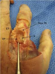 Describe your issuethe assistant will guide you. Dorsal View Of The Dislocated Index Mcp Joint After Excision Of The Download Scientific Diagram