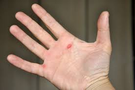 Doigts de la main droite sectionnés au niveau de la deuxième phalange. Bataturi La Mana Bataturile Tenismenului