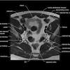 The back anatomy includes the latissimus dorsi, trapezius, erector spinae, rhomboid, and the teres significant. 1