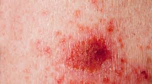 Sccs can disfigure the skin, especially on the face. Signs Of Late Stage Skin Cancer