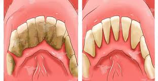 Последние твиты от ann tartre (@anntartre). Astuce Maison Pour Enlever Le Tartre Dentaire Soi Meme