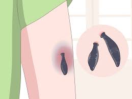 3 Ways To Make A Bruise Go Away Faster - Wikihow