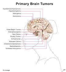 Primary Brain Tumors Oncology Medbullets Step 1