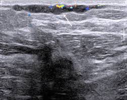 It is caused by blood clotting in these veins. An Unusual Cause Of Breast Pain