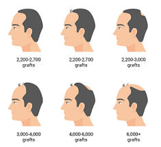 How many grafts do i need to restore my hairline? How Many Hair Grafts Are Required For A Hair Transplant Quora