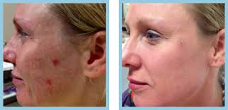 You are doing a chemical exfoliation, so be careful. Chemical Peels Nashville Vitalize Peel Franklin Skin Resurfacing Mt Juliet