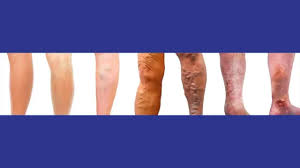 Image result for Pigment stains on the shin