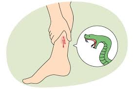 Image result for Snake Bite