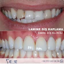 Lamine Dis Kaplama Ortodonti Dis Saglikli