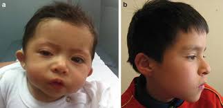 Medical conditions that cause the nasal bridge not to mature and project are associated with epicanthic folds. Oculofacial Manifestations Of Chromosomal Aberrations Ento Key