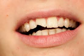 Image result for Tooth Fracture