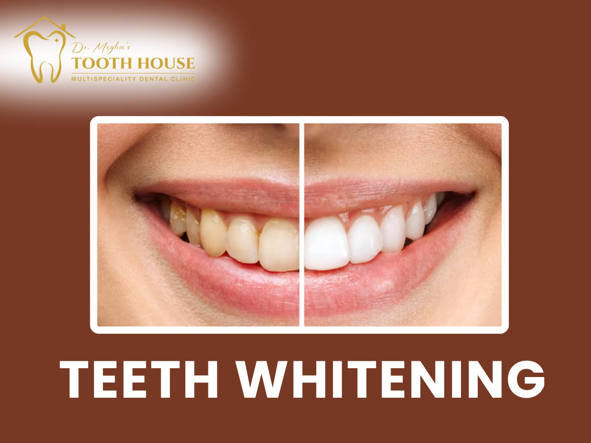 Teeth Whitening product image