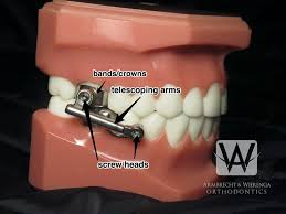 How to stop elastic braces pain. Braces Care Guide Frequently Asked Questions About Braces Grand Rapids Orthodontists
