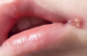 Herpes an den lippen kennt fast jeder: Herpes Bei Kindern Und Babys Lippenherpes Ratgeber