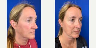 Top Lightsheer Laser Providers in Austin, TX