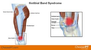 Individual throttle body, a throttle unit for an engine cylinder. Physical Therapy Guide To Iliotibial Band Syndrome Itbs Or It Band Syndrome Choosept Com
