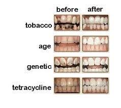 When You Get Up In The Morning Before You Eat Or Drink Anything Put 1 2 To 1 Tablespoon Of Oil In Your Coconut Oil For Teeth Oil Pulling Coconut Oil Pulling