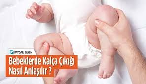 bebeklerde kalca cikigi nasil anlasilir bebek kalcalar hamilelik