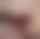 Image result for Cardiac Pacemaker Infection