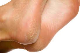 This is a condition of small blisters that may develop on the feet. Can You Recognize Plantar Warts On Feet