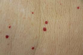 As time passes they may develop to as big as ½ cm. Vascular Tumors Cardiovascular Medbullets Step 1