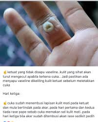 Ketuat terjadi disebabkan oleh jangkitan virus, human papillomavirus (hpv). Cara Hilangkan Ketuat Yang Anda Boleh Saya Orang Johor Facebook