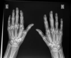 Image result for Hand Fracture