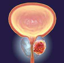 Pain in the bones of those areas loss of weight and appetite fatigue,. Experienced Prostate Cancer Specialists In Singapore Tan Urology