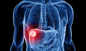 She weighed so little they weren't sure about the right dosage of the drugs she needed. Hepatocellular Carcinoma Or Liver Cancer Symptoms Treatment Prognosis Narayana Health