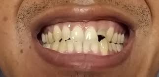 การ ต่อ ฟัน เบทโฮเฟิน