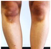 Discolouration of the skin after application of ...