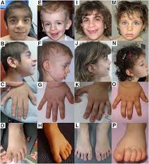 27+ toll bilder ab wann gibt man brei / ab wann mu. Exome Sequencing Unravels Unexpected Differential Diagnoses In Individuals With The Tentative Diagnosis Of Coffin Siris And Nicolaides Baraitser Syndromes Springerlink