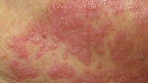 Many of these are available. Yeast Infection On Face Symptoms Causes Diagnosis And Treatment