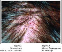 A cherry angioma (also commonly called cherry hemangiomas, campbell de morgan spots, or senile angioma) is a bright red or purple spot made up of blood vessels. Cherry Hemangioma In The Scalp